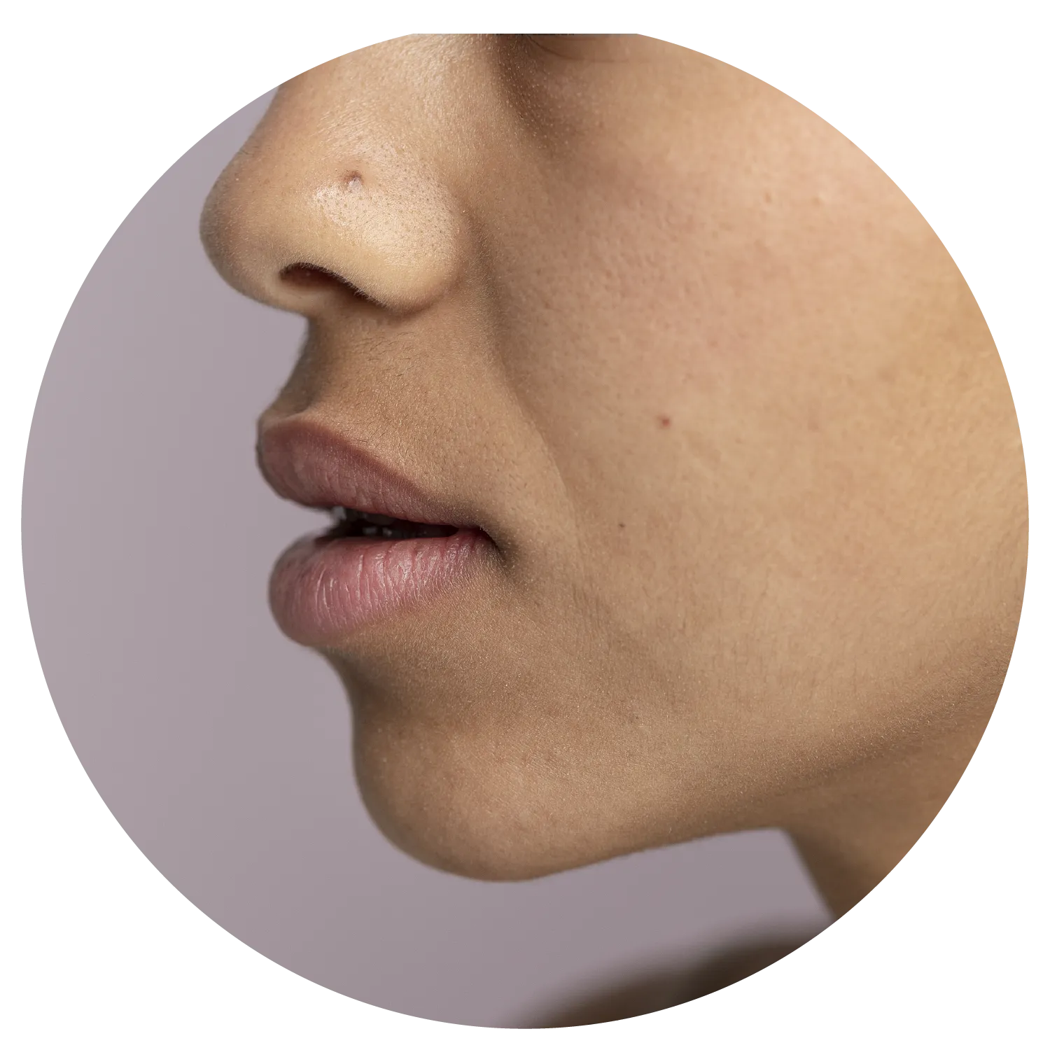 Smile Lines treatment process at Toronto medical spa - Understand the deeper factors behind smile lines
